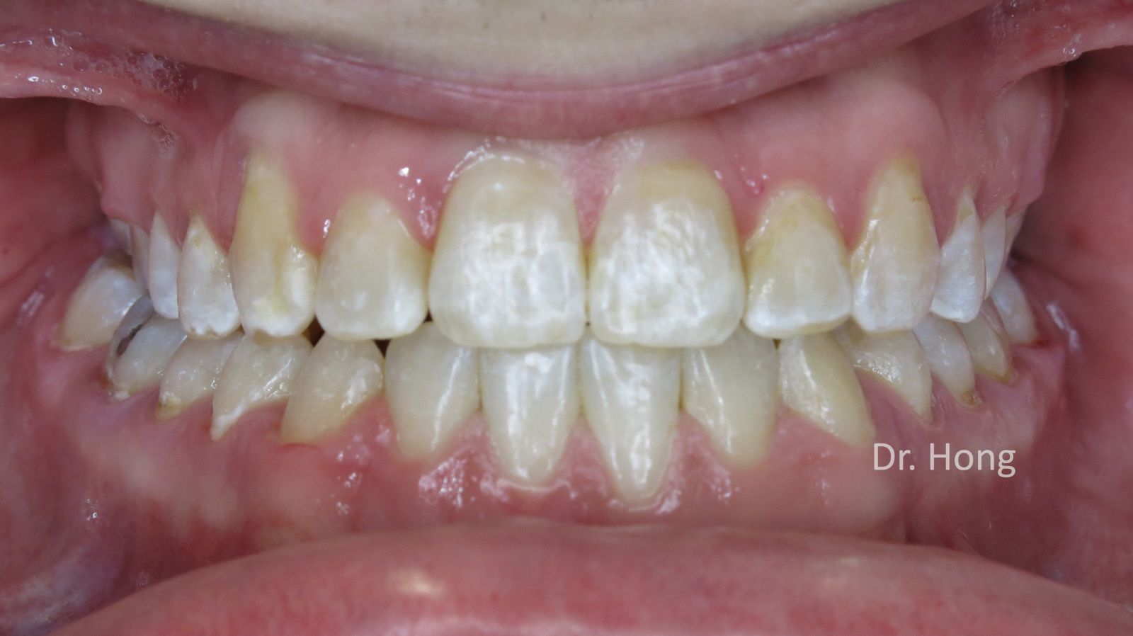 NonSurgical & NonExtraction Treatment Oakridge Orthodontics